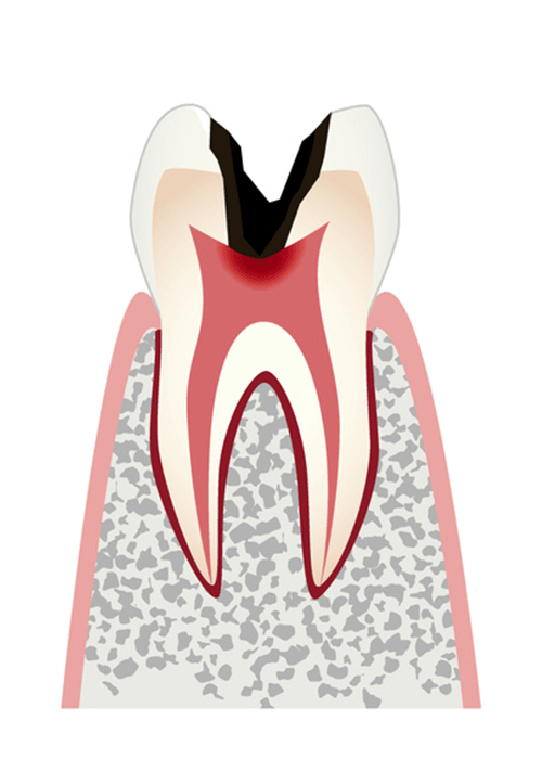 C3.歯の神経まで進行した虫歯