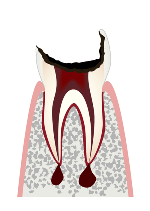 C4.歯の神経が失われた歯